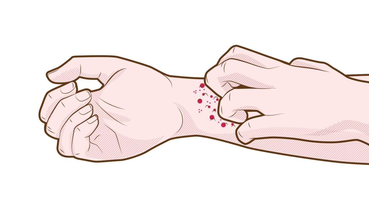 psoriase