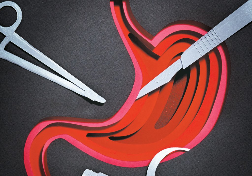 Para quem é a cirurgia bariátrica