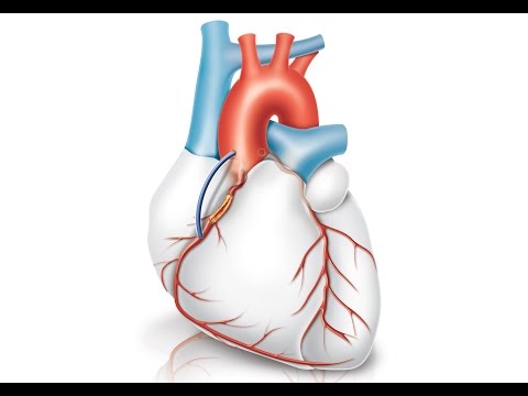 Como é feita uma ponte de safena?