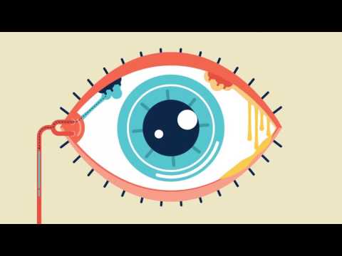 Como surge a remela?