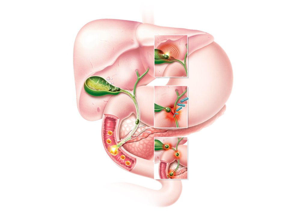 Não precisa de cirurgia? Esclareça 5 mitos sobre pedras na vesícula