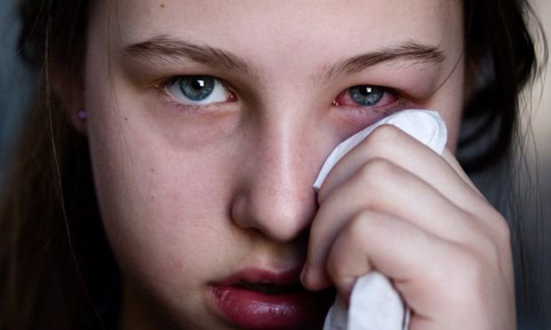 Conjuntivite Conjuntivite