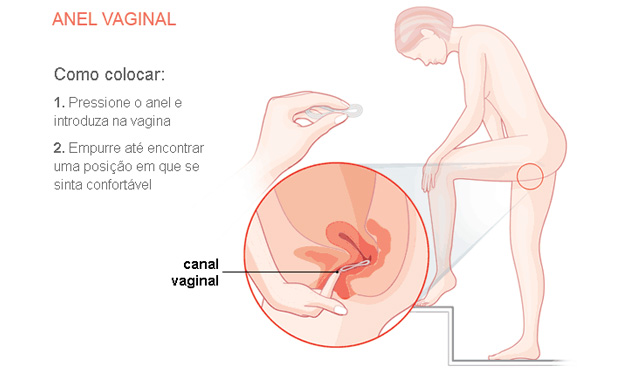 Anel vaginal