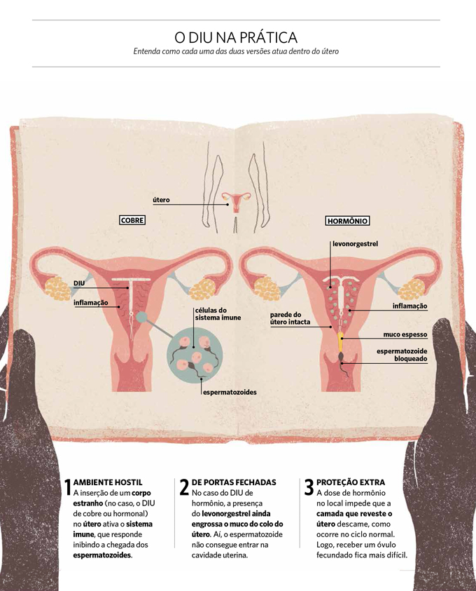 O DIU na pr&aacute;tica