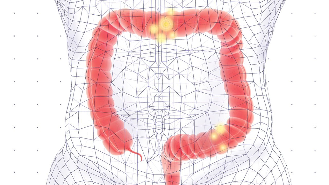 antibióticos-câncer-de-intestino