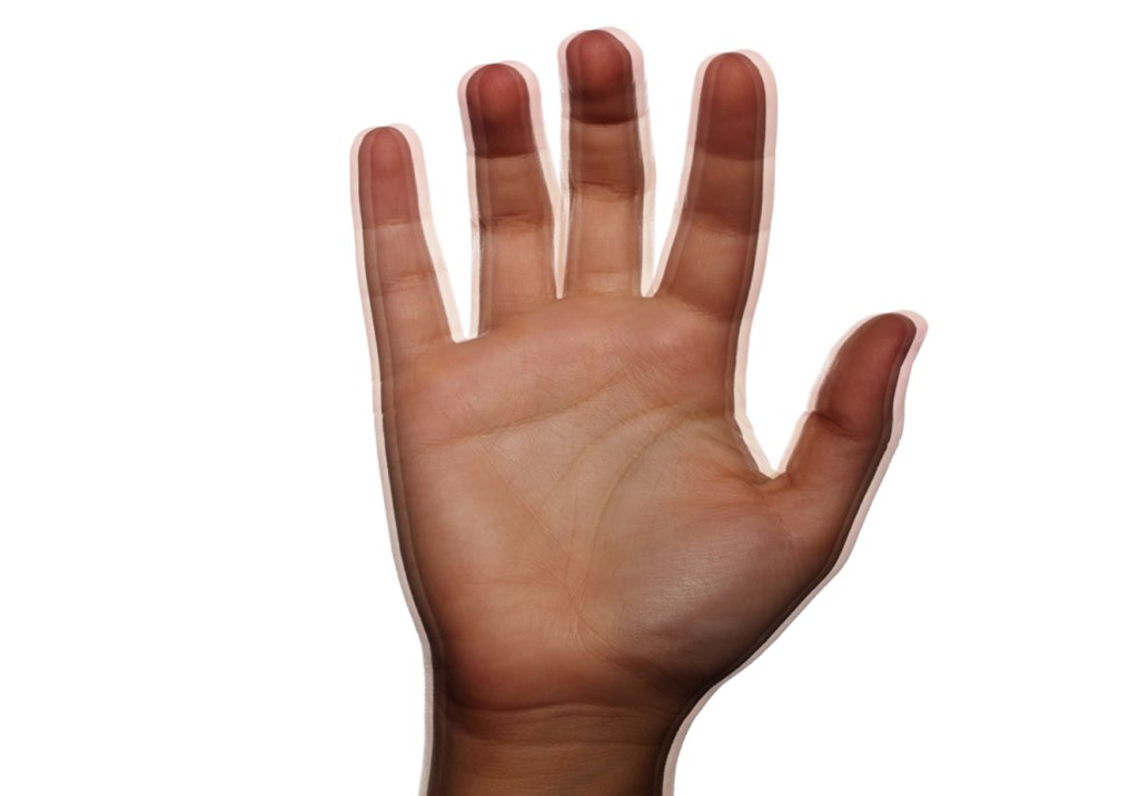 Encontrado um elo entre um tipo de câncer de pele e o Parkinson