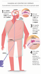 AVC Cirurgia por cateter