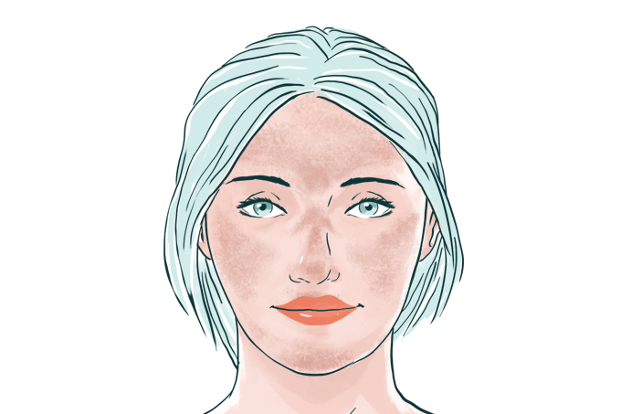 melasma