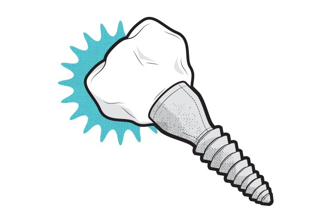 Implante dentário e dentadura
