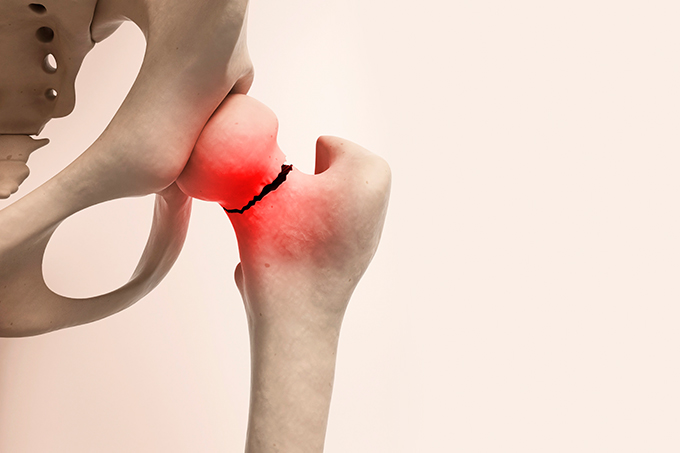 remedio para osteoporose