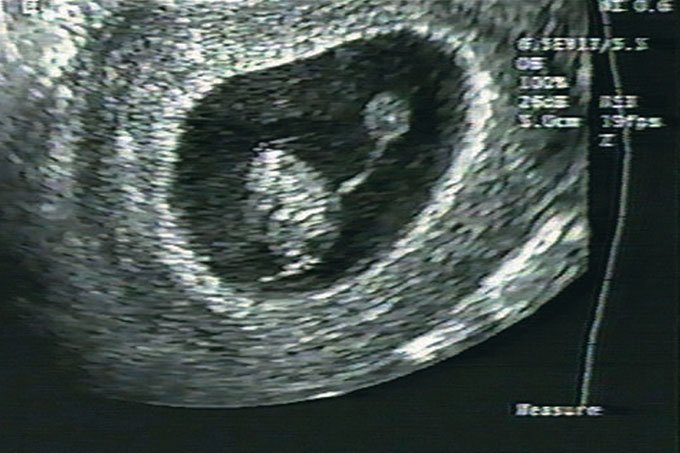 O que é sofrimento fetal e quais suas repercussões ao longo da vida