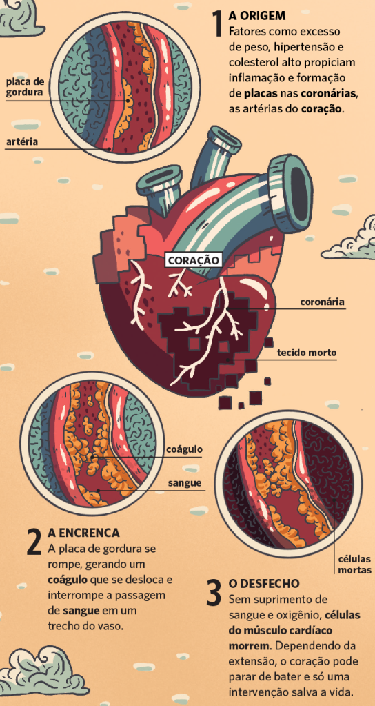 Infarto no coração jovem