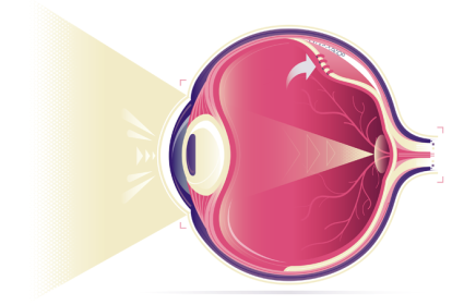 cirurgia de descolamento de retina