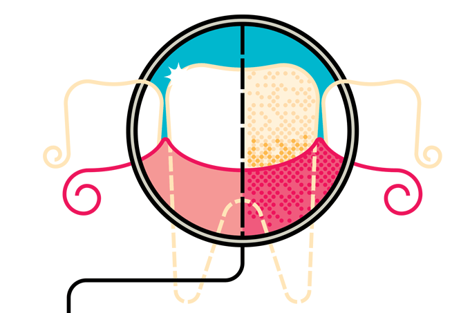 O que é a gengivite? Saiba como prevenir e tratar