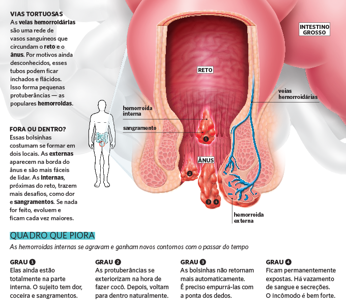 Como se formam as hemorroidas?