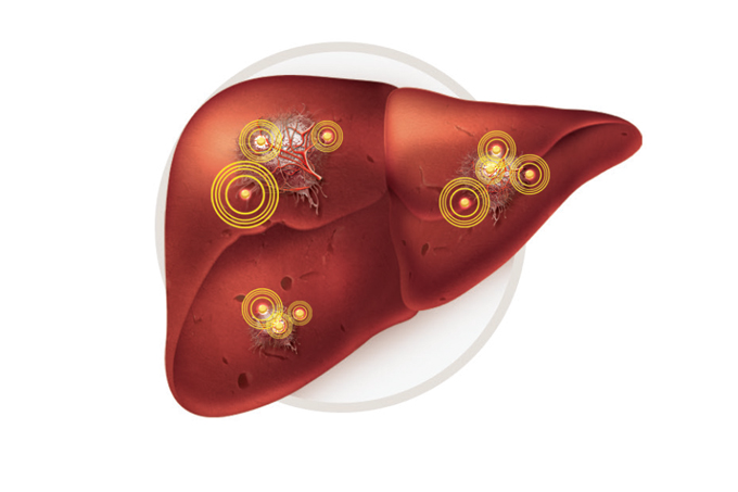 hepatite c causa diabetes?