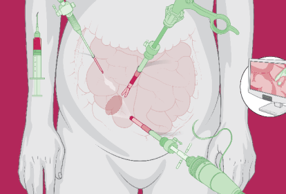 ilustração de uma barriga com instrumentos de laparoscopia, uma cirurgia