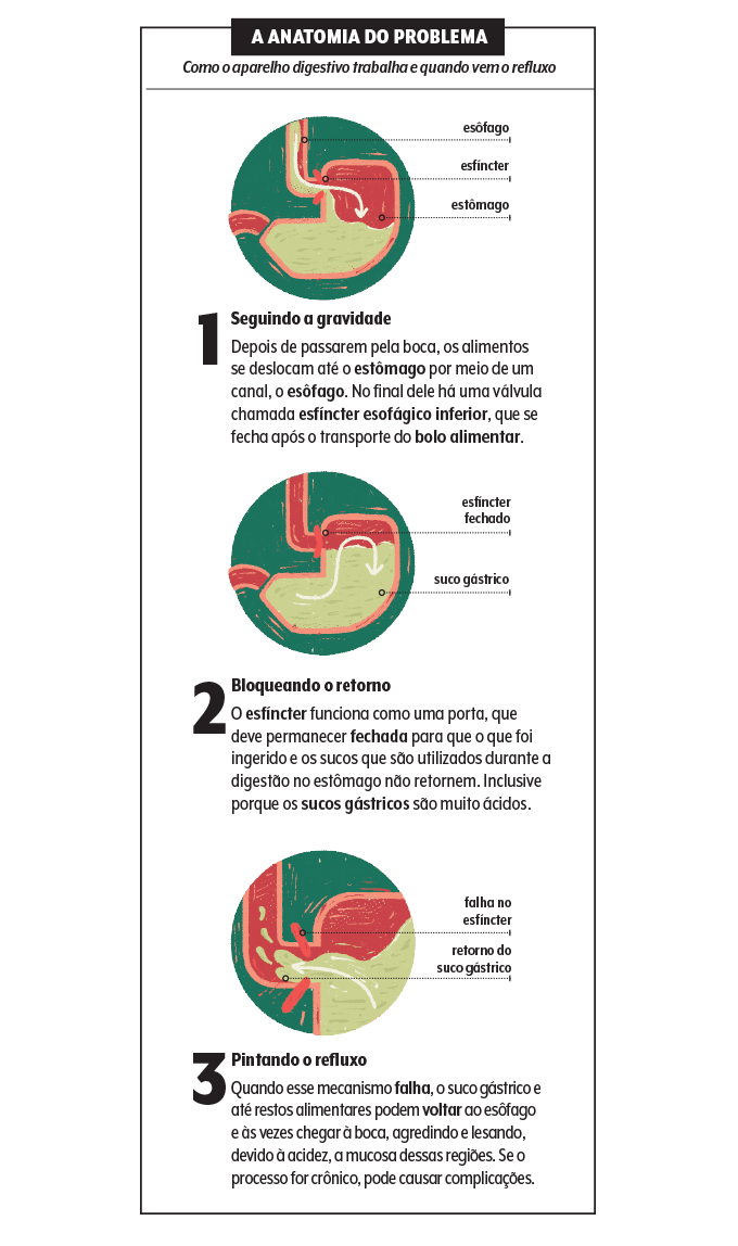 infografico refluxo 1 Infográfico sobre como funciona o refluxo
