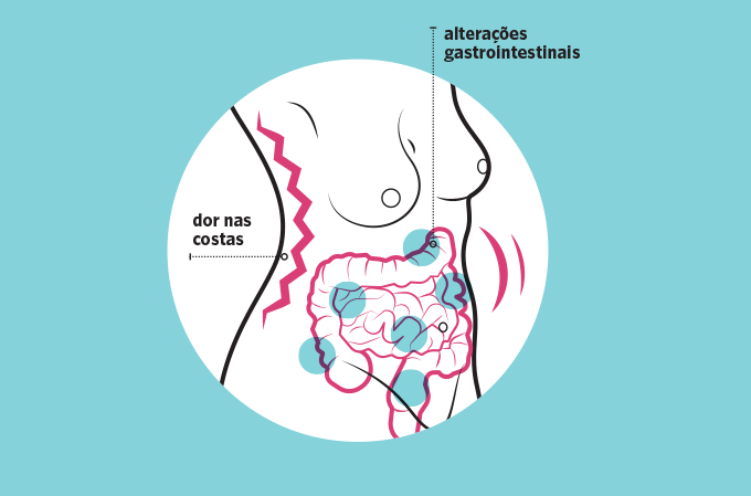 Problemas da diástase para a saúde