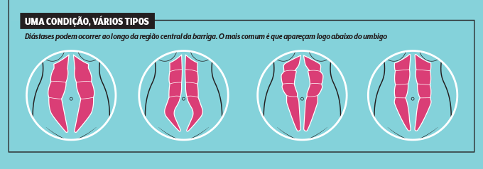 Tipos de di&aacute;stase