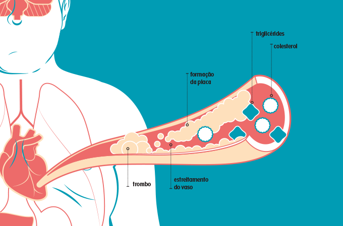 ilustração de formação de placa e trombos na artéria
