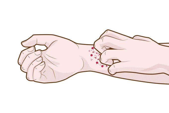 Sarna humana: o que é, como identificar e prevenir?