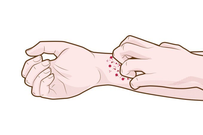 Sarna humana: o que é, como identificar e prevenir?