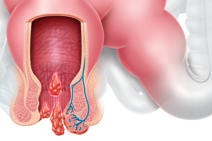 Tratamento inédito para hemorroidas evita internação e agiliza recuperação