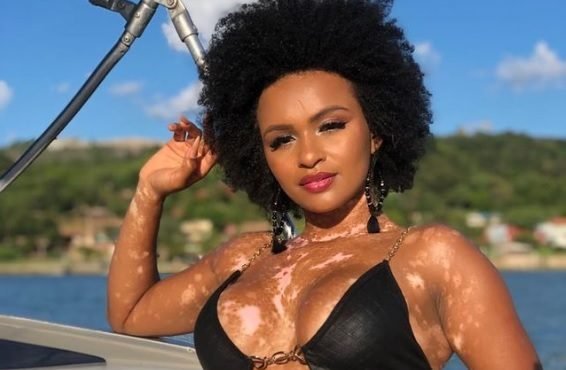 Participante do BBB com vitiligo gera debate sobre aceitação e preconceito