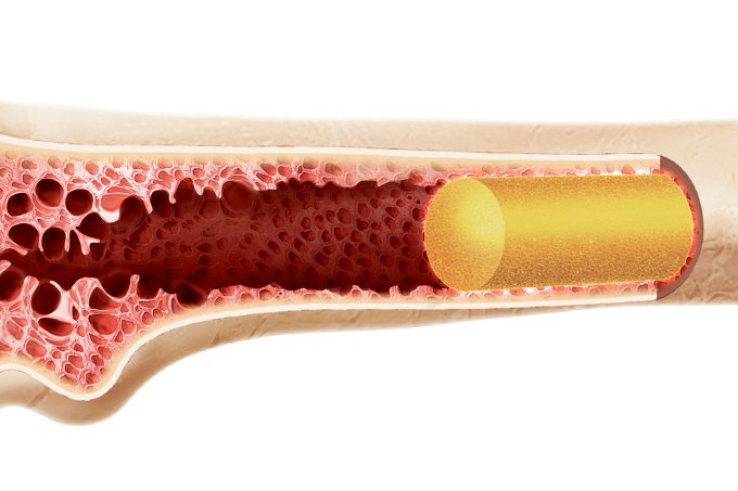 Um novo futuro para os pacientes com anemia aplástica severa