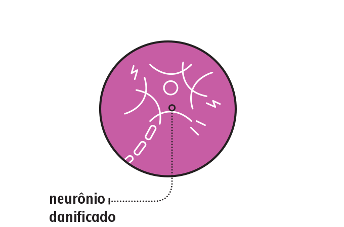 Neurônio afetado por microtrombo Neurônio afetado por microtrombo