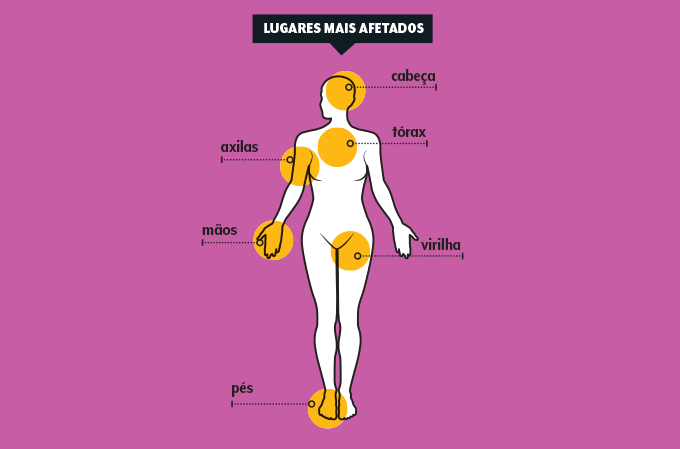 lugares afetados pela hiperidrose Locais onde se manifesta a hiperidrose