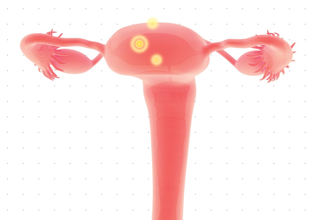 Vacina contra o câncer do colo de útero pode eliminar tumores