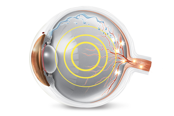 causas do glaucoma