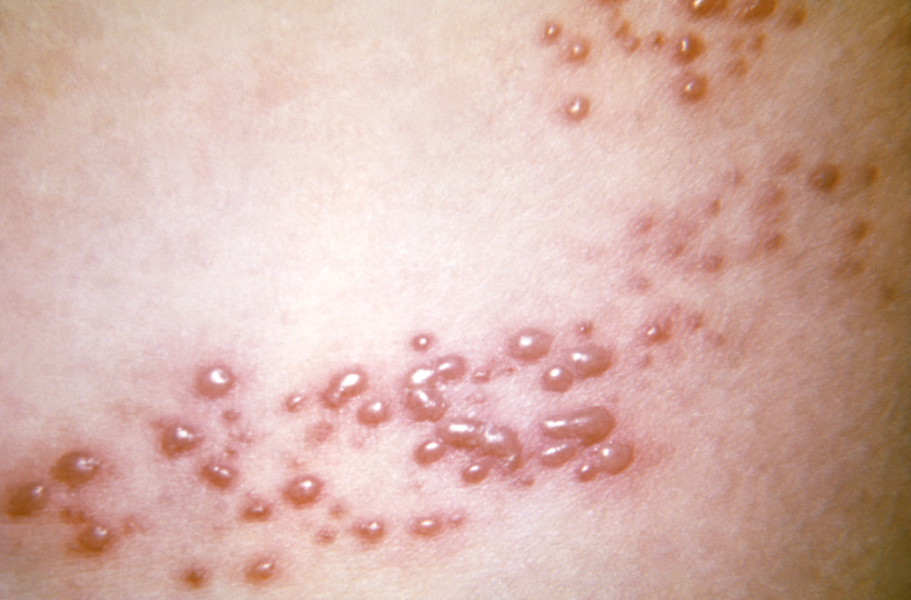 1 em cada 3 pessoas terá herpes-zóster ao longo da vida, saiba como evitar