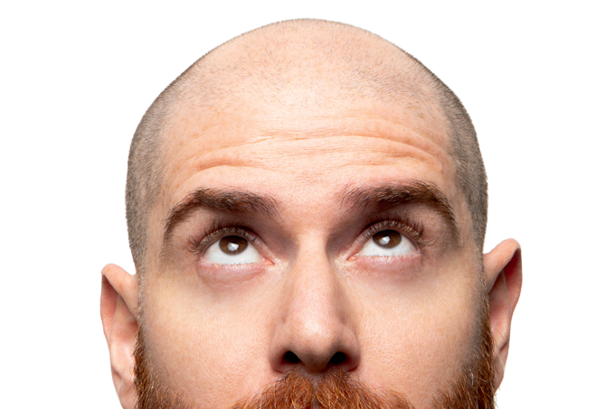 Um remédio para alopecia areata