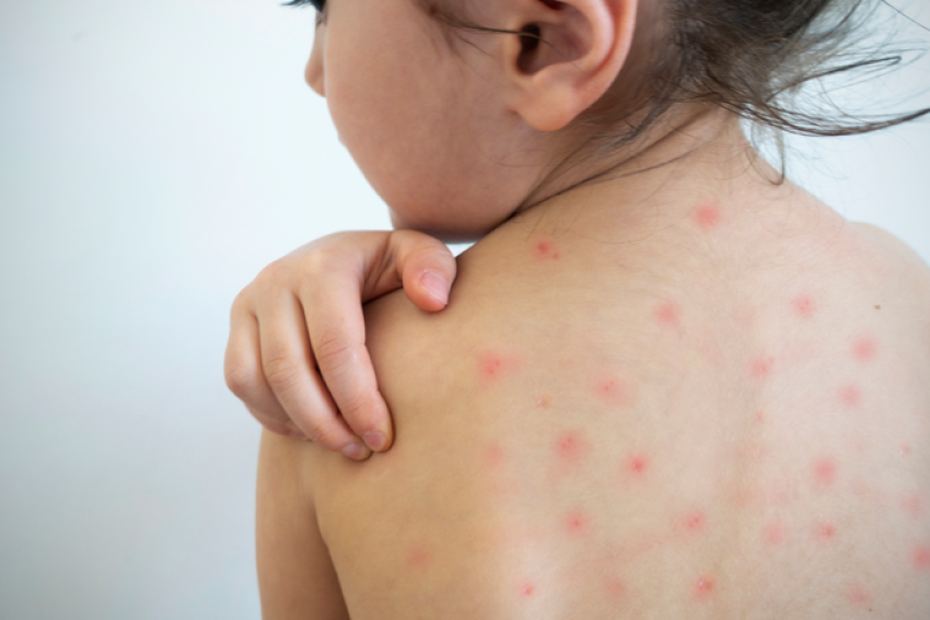 Sarampo: baixa adesão à vacina preocupa, e fim da campanha é adiado