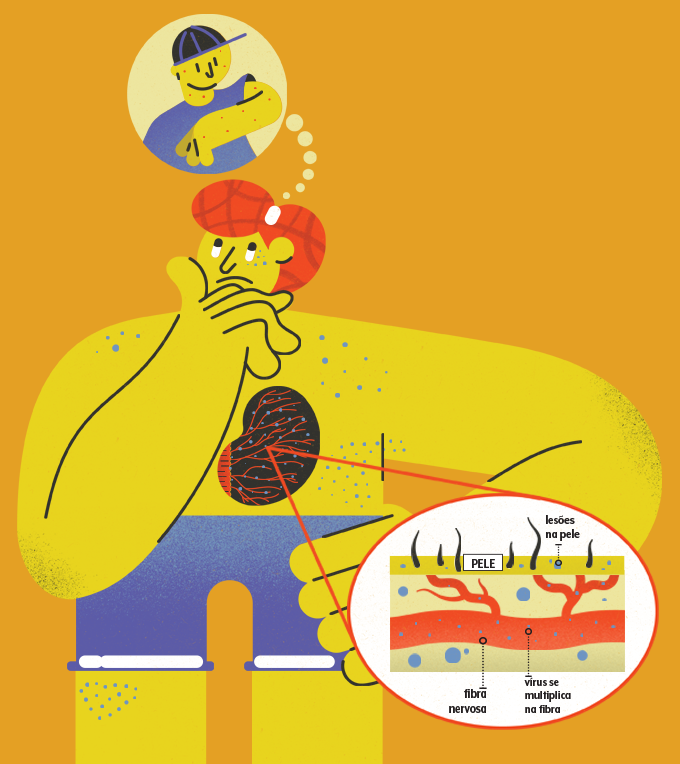 esquema pele herpes-zoster