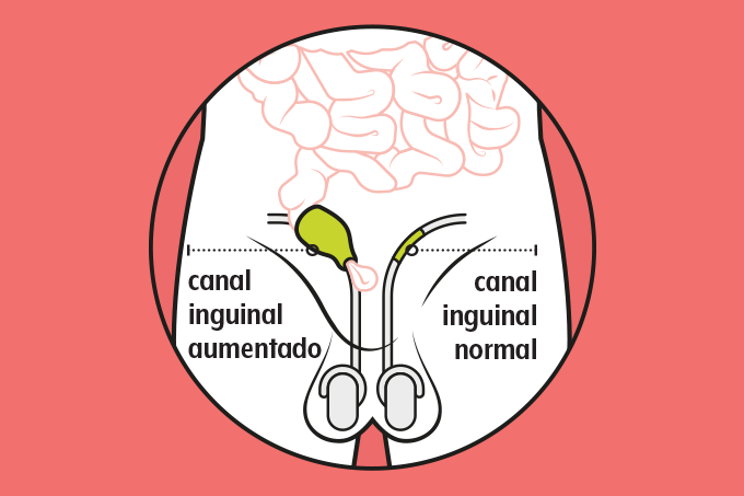 Hérnia inguinal em homens desenho de canal inguinal