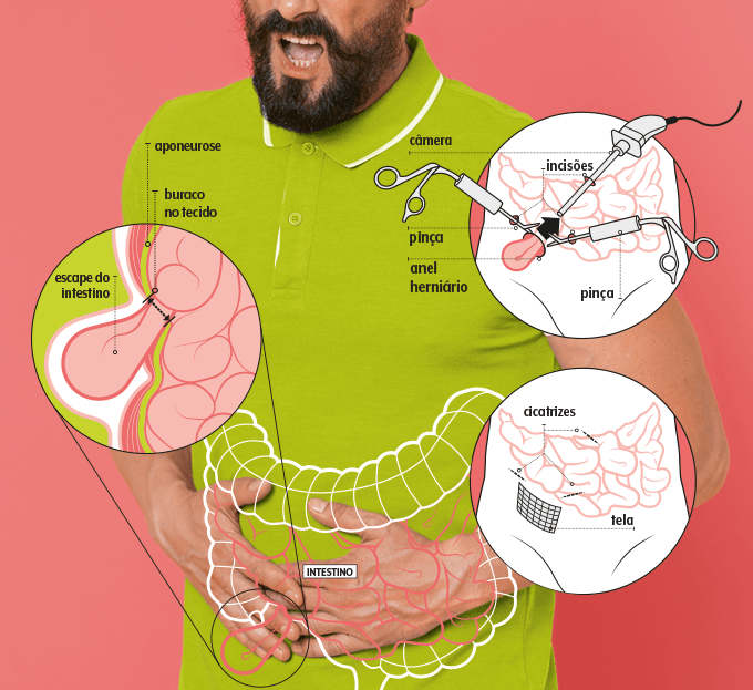 Hérnia inguinal foto de homem com desenho de órgãos e