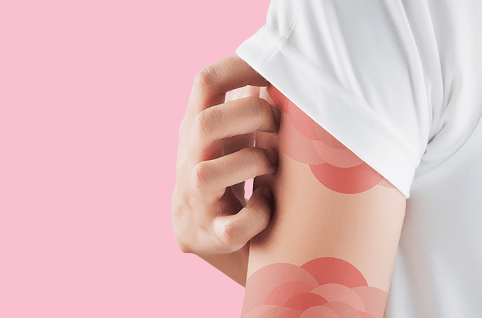 Dermatite atópica: desconhecimento compromete diagnóstico e tratamento