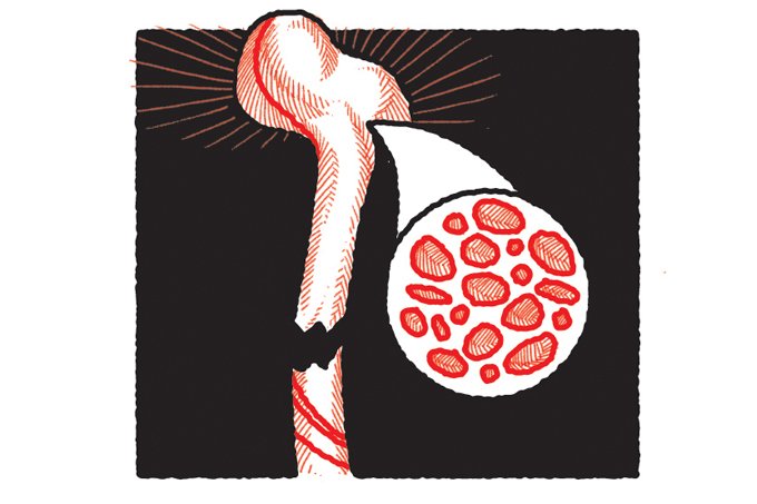 Osteoporose: novo tratamento de ponta chega ao SUS
