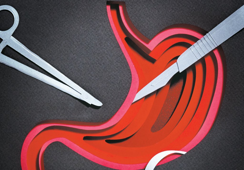 Cirurgia bariátrica: novas diretrizes sugerem liberá-la para mais gente