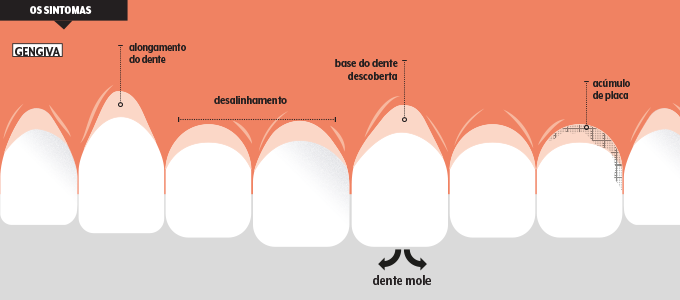 sintomas retração gengival