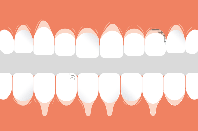 O que é e o que causa a retração de gengiva?
