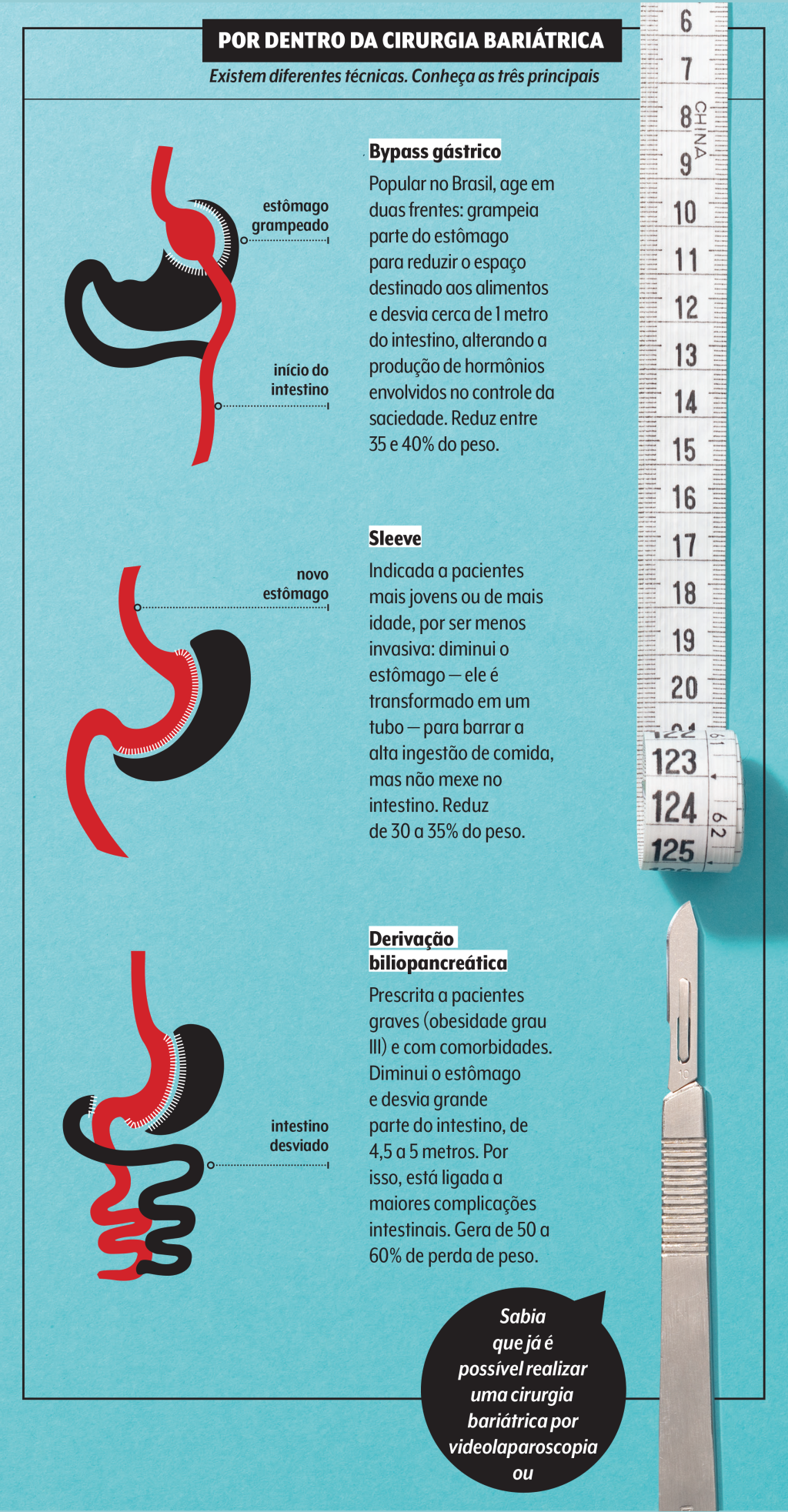 técnicas cirurgia bariátrica