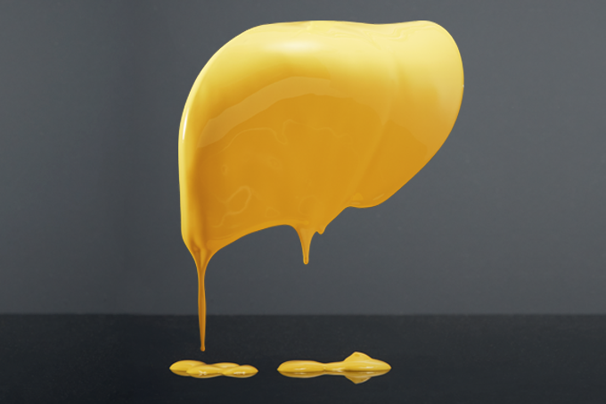 Quando a gordura se acumula no fígado − e em outros órgãos