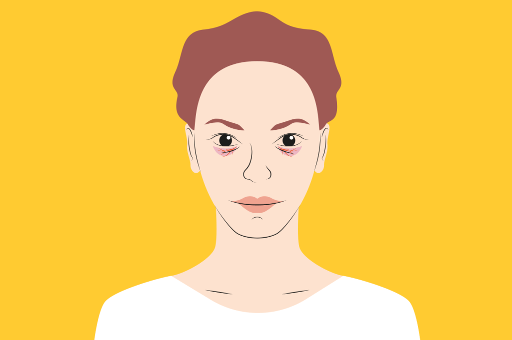 Olheiras: quais os tipos e as estratégias mais eficazes para tratar?