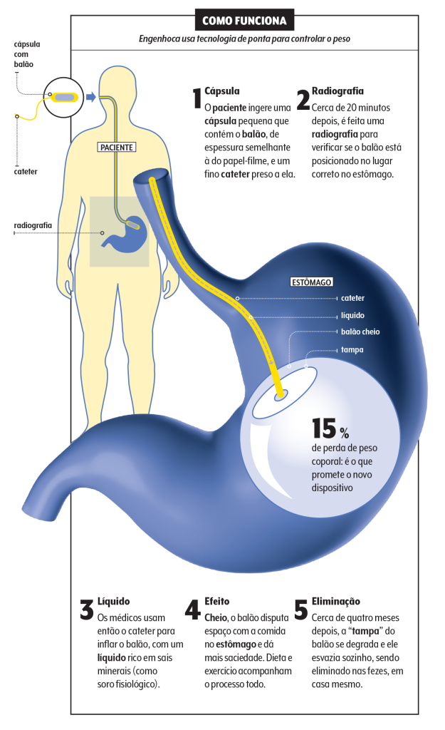 capsula-cirurgia-bariatrica-balao-deglutivel