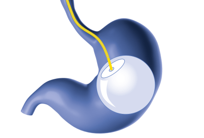 estomago-cirurgia-com-capsula-deglutivel